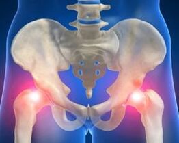 causas de artrose da articulação do quadril