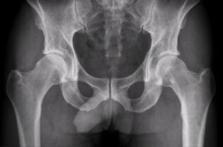 opções para diagnosticar artrose da articulação do quadril