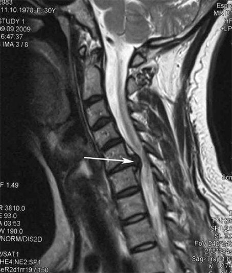 Lesão na medula espinhal desencadeia dor no pescoço