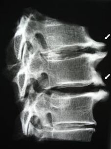 Osteófitos da coluna cervical causam dor no pescoço