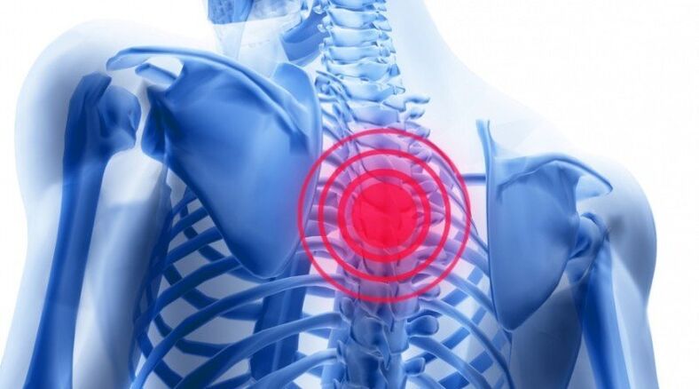 dor nas costas pode estar associada a uma hérnia de disco