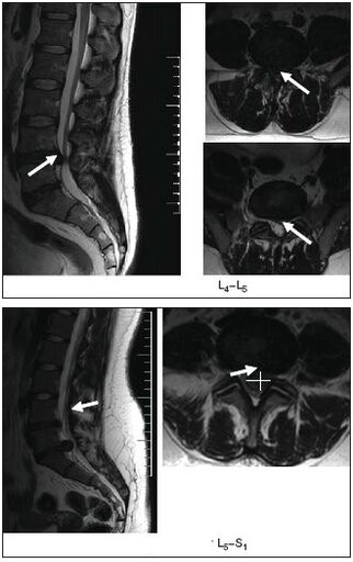 Exame de ressonância magnética da hérnia de disco da coluna vertebral
