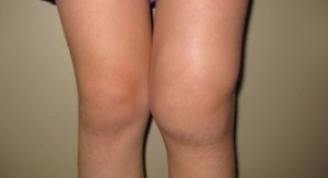 A deformidade do joelho