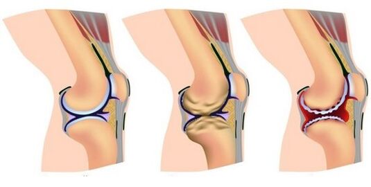 uma articulação saudável e dor na destruição da articulação do joelho