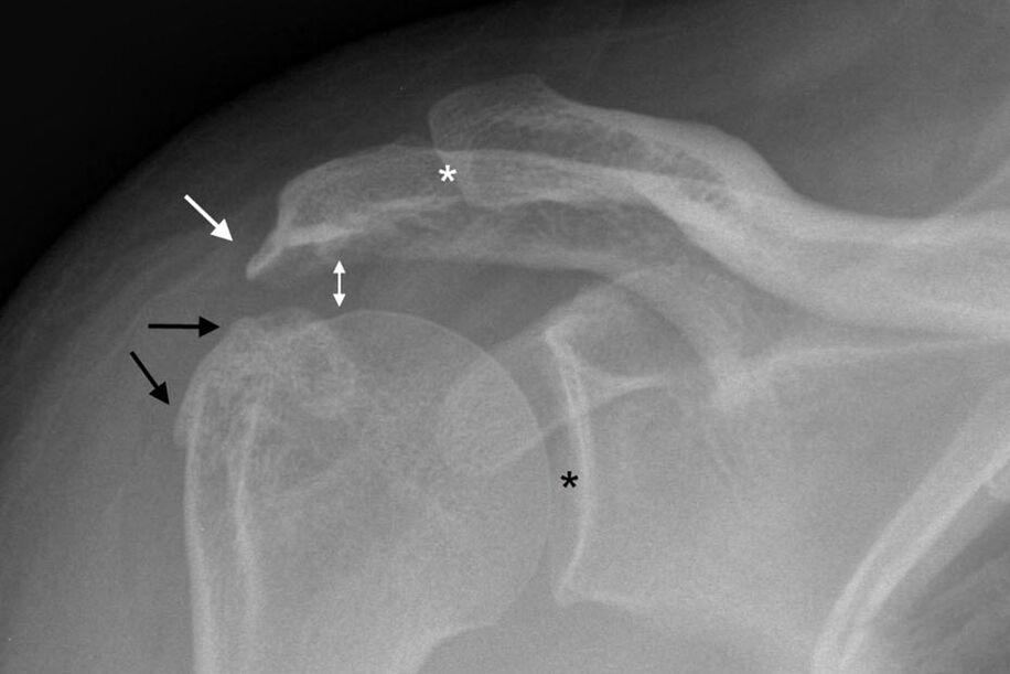 artrose da articulação do ombro no raio-x