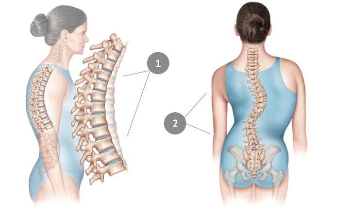 curvatura da coluna vertebral como causa de osteocondrose torácica