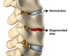 um disco normal da coluna vertebral, um disco danificado